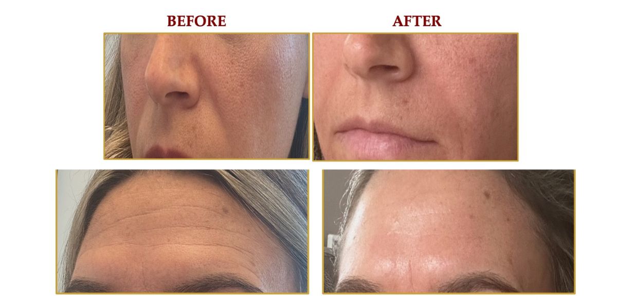 Before and after NOUVADerm treatment showing smoother and tighter skin at Sundrata Clinic